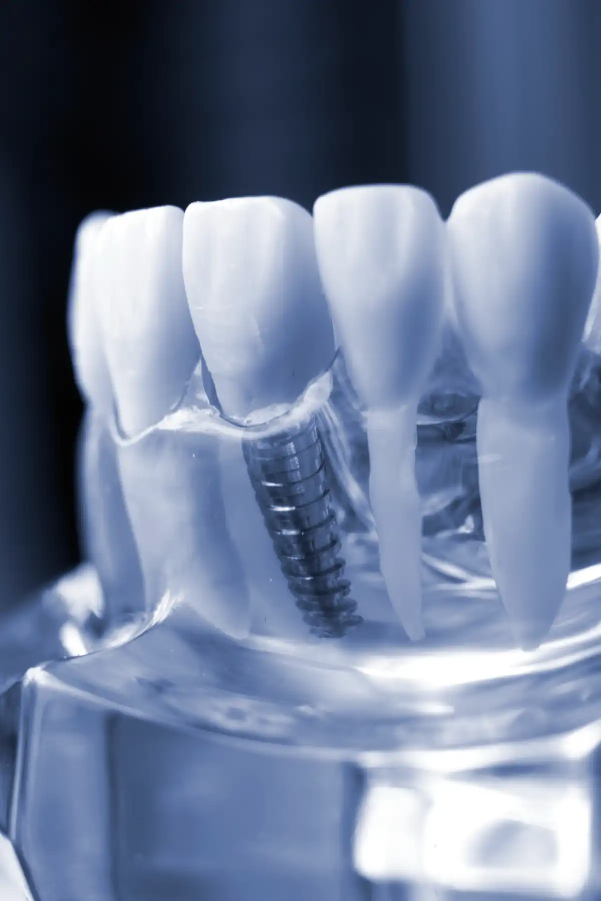 Implantes Dentales Zipaquira